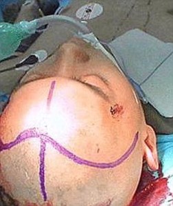 Kondisi Wei  setelah operasi mengeluarkan pisau  dari kepalanya selesai/dailymail
